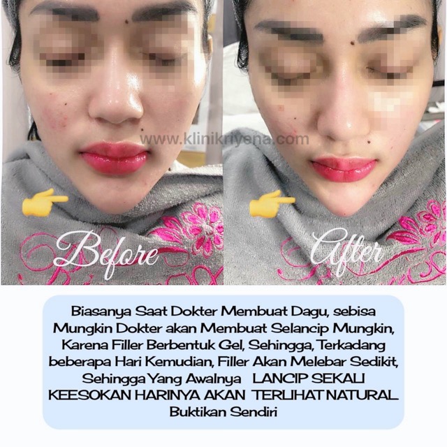 Chin Filler : Patient of Riyena Orthomedik