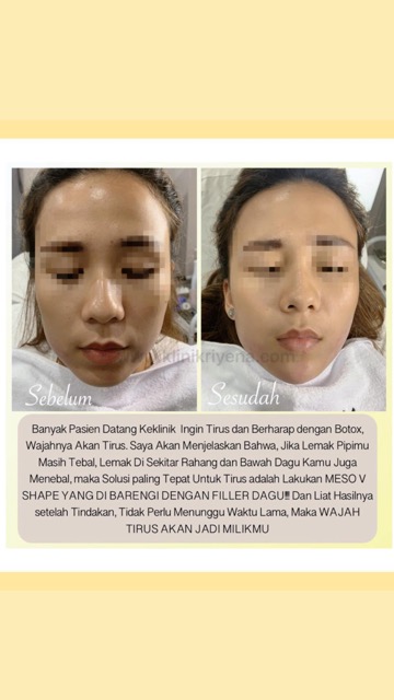 Chin Filler : Patient of Riyena Orthomedik