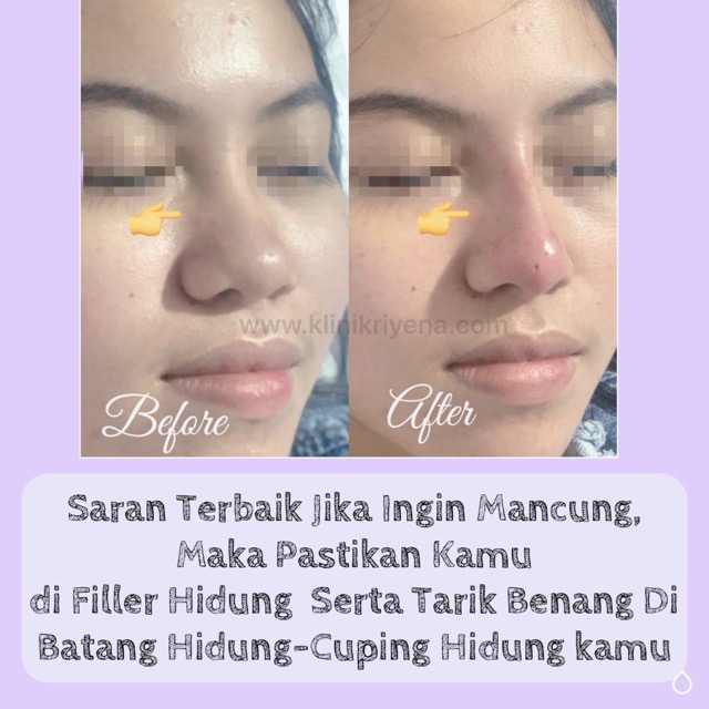 Chin Filler : Patient of Riyena Orthomedik