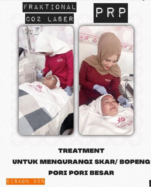 Scar Treatment with PRP & Fractional CO2 Laser